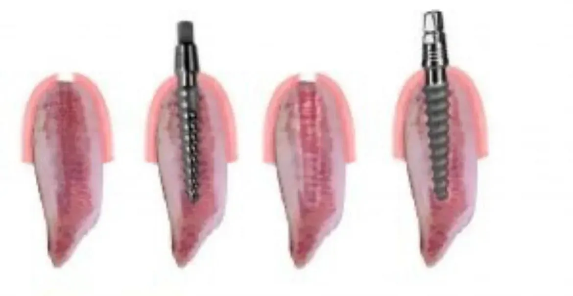 Un primer plano de un diente con un tornillo en él.