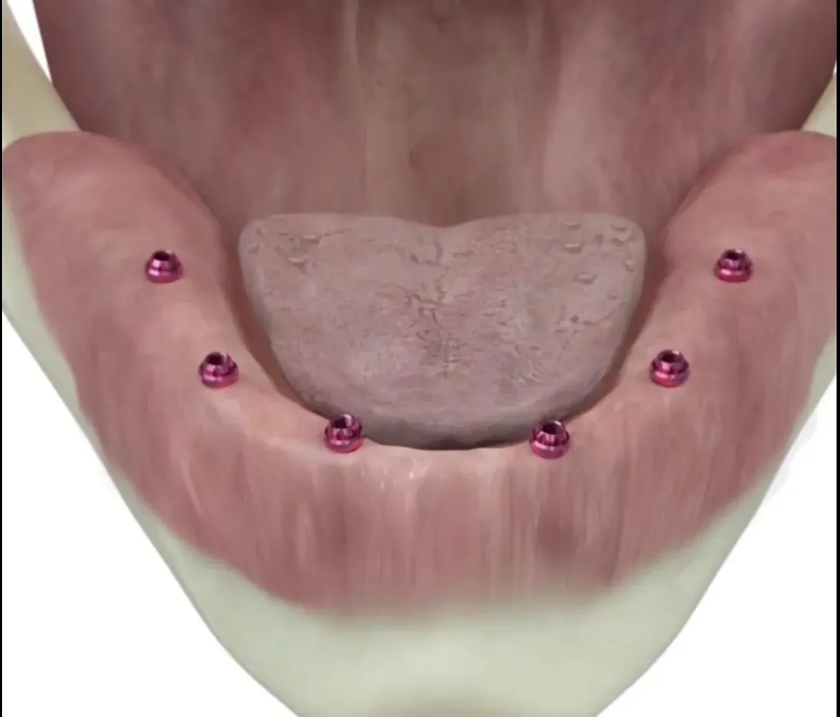 Un primer plano de la boca de una persona con tornillos en ella.