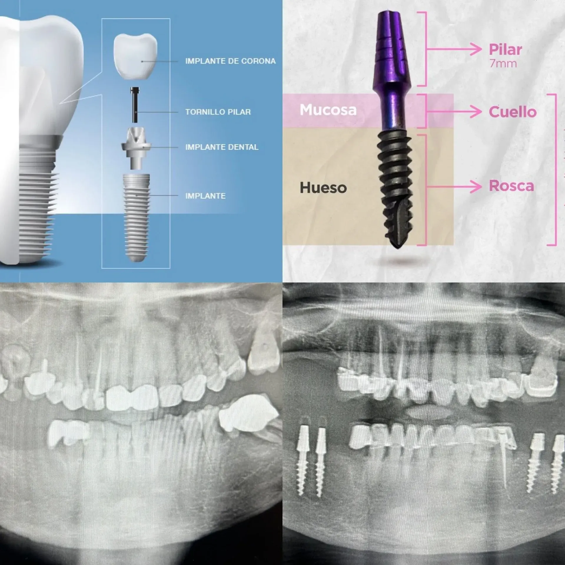 Un diagrama de un implante dental y una radiografía de un diente.