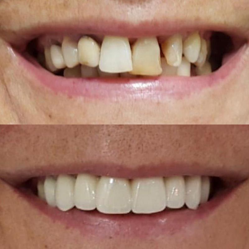 Arriba: Boca con dientes desiguales y descoloridos. Abajo: Boca con dientes rectos y blancos.