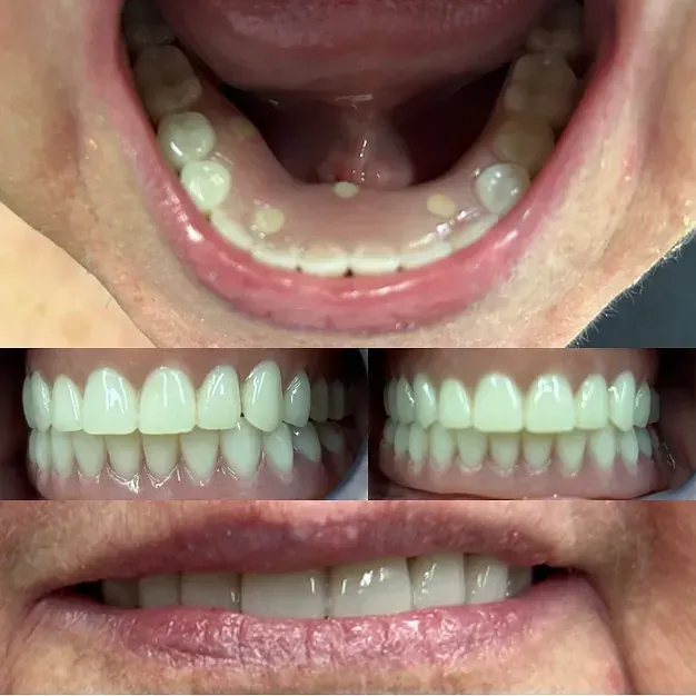 Un primer plano de los dientes de una persona antes y después del trabajo dental.