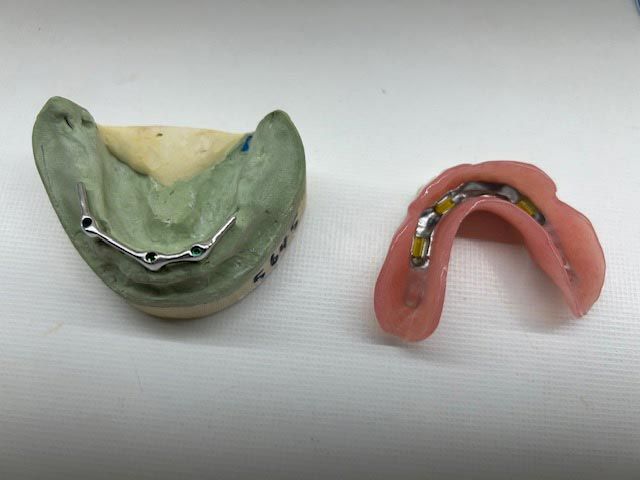 Dos dentaduras postizas parciales, una de molde verde y otra de color rosa, mostrando accesorios metálicos.