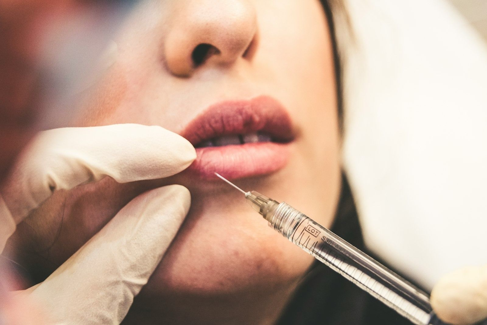 Gros plan d'une main gantée injectant un produit de comblement dans les lèvres d'une personne à l'aide d'une seringue
