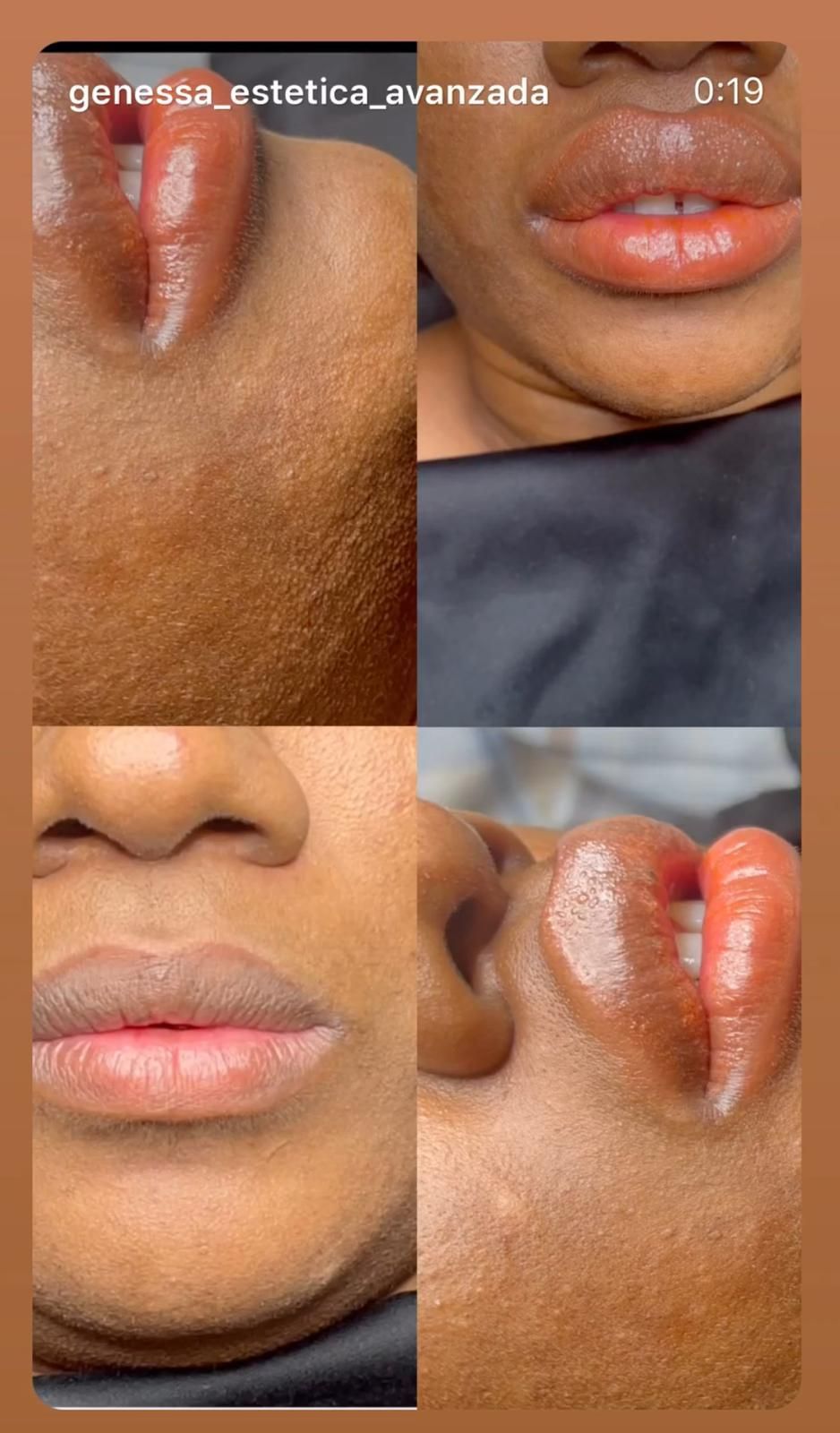 Comparación del rostro antes y después del tratamiento, mostrando reducción de arrugas y manchas.