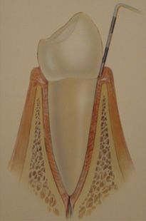 Zeichnung eines Zahnes bei dem mit einem Plättchen die Zahnfleischtasche gemessen wird. Das Zahnfleisch ist leicht entzündet