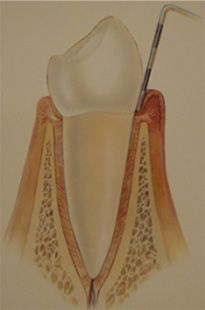 Zeichnung eines Zahnes bei dem mit einem Plättchen die Zahnfleischtasche gemessen wird. Das Zahnfleisch ist stark entzündet.