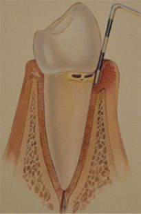 Zeichnung eines Zahnes bei dem mit einem Plättchen die Zahnfleischtasche gemessen wird. Das Zahnfleisch ist stark entzündet und der Kieferknochen ist angegriffen