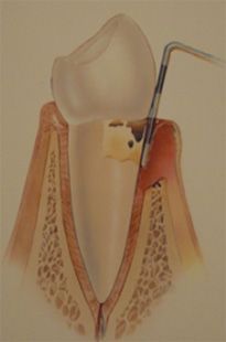 Zeichnung eines Zahnes bei dem mit einem Plättchen die Zahnfleischtasche gemessen wird. Das Zahnfleisch ist stark entzündet und der Kieferknochen ist stark angegriffen