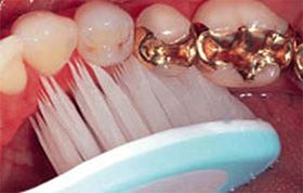 Detail einer Zahnbürste, die gerade in einem Mund n den Zähnen ansetzt. Zwei Zähne haben Teil-Goldkronen