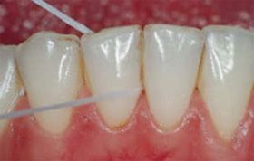 Foto einer Zahnreihe, wo ein Zahn gerade mit Zahnseide gereinigt wird