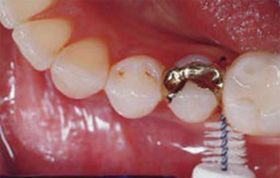 Detail einer Interdentalbürste, die gerade in einem Mund n den Zähnen ansetzt. Zwei Zähne haben Teil-Goldkronen