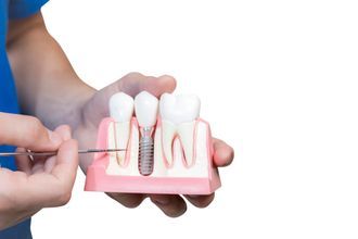 Implantologie in einem Zahnmodell
