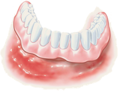 Entzündetes Zahnfleisch bei einer Prothese