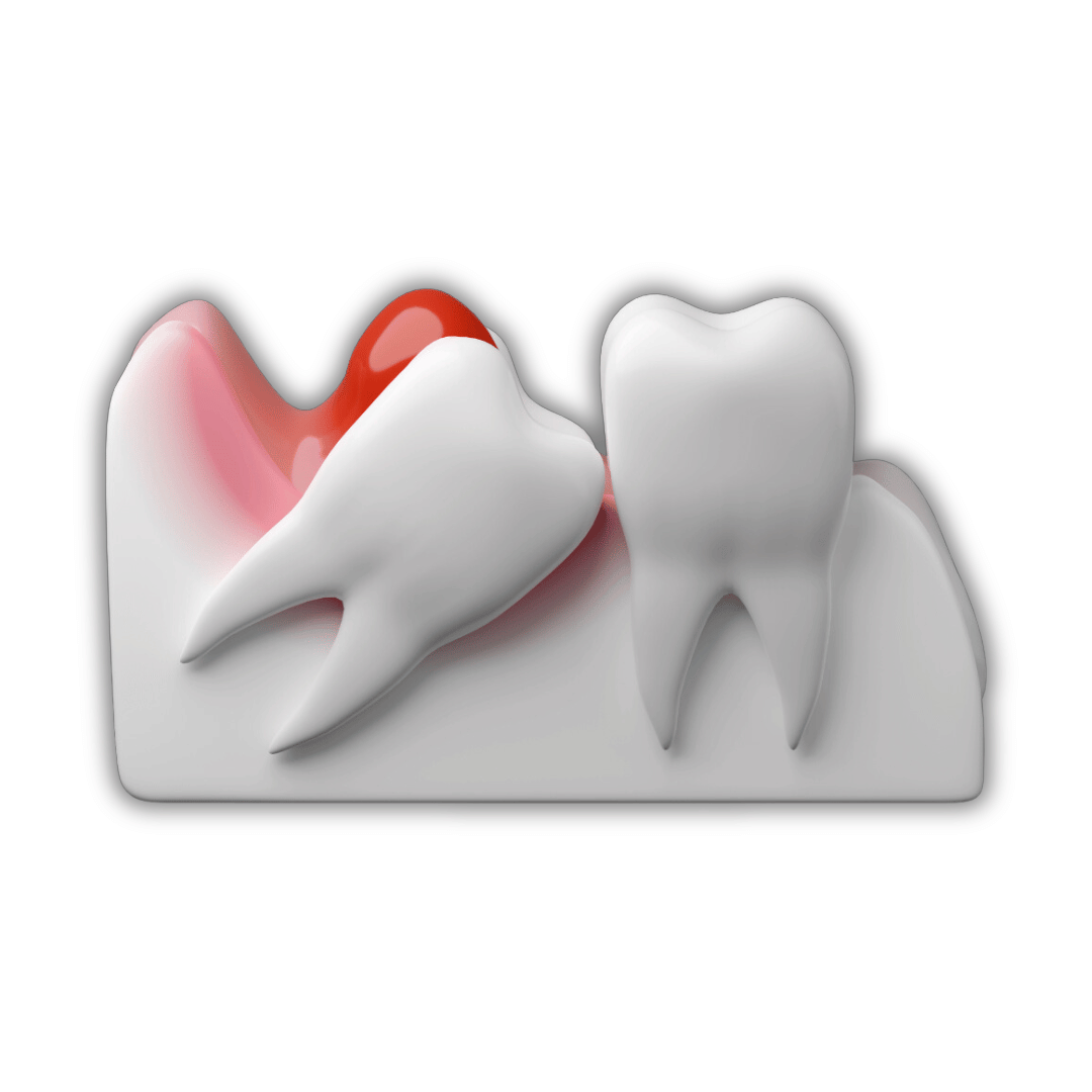 خلع ضرس العقل باستخدام تقنيات حديثة