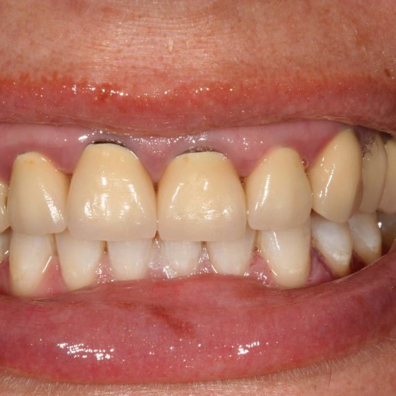 Beschädigungen an den oberen Schneidezähnen