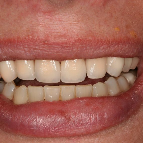 Schneidezähne sehen wieder ästhetisch schön aus