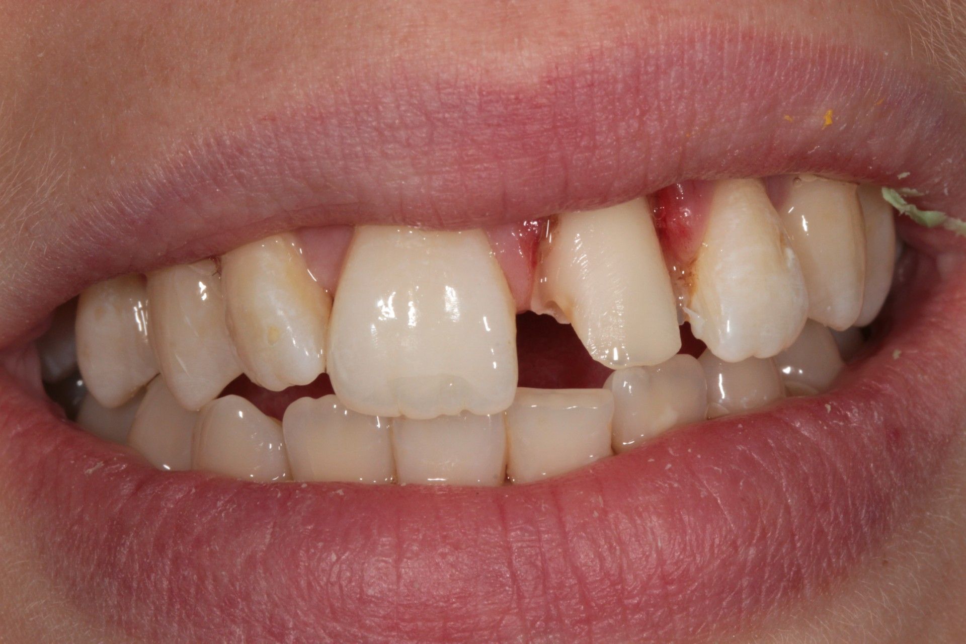 Zahnfront mit Schneidezahn, der teilweise abgebrochen ist und das Zahnfleisch darum ist wund