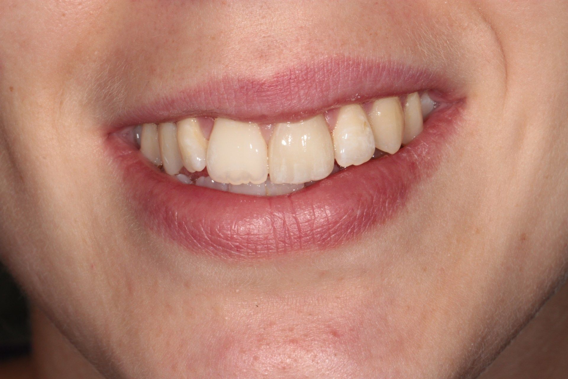 Jetzt ist die Zahnfront wieder ästhetisch schön korrigiert