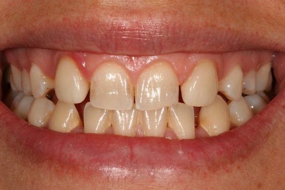 VORHER Patientin mit Oligodontie