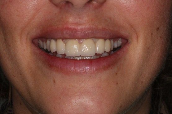 NACHHER Zirkonbrücke von 13-23