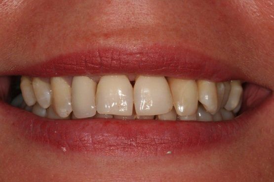 VORHER Patientin mit parodontal geschädigten Zähnen