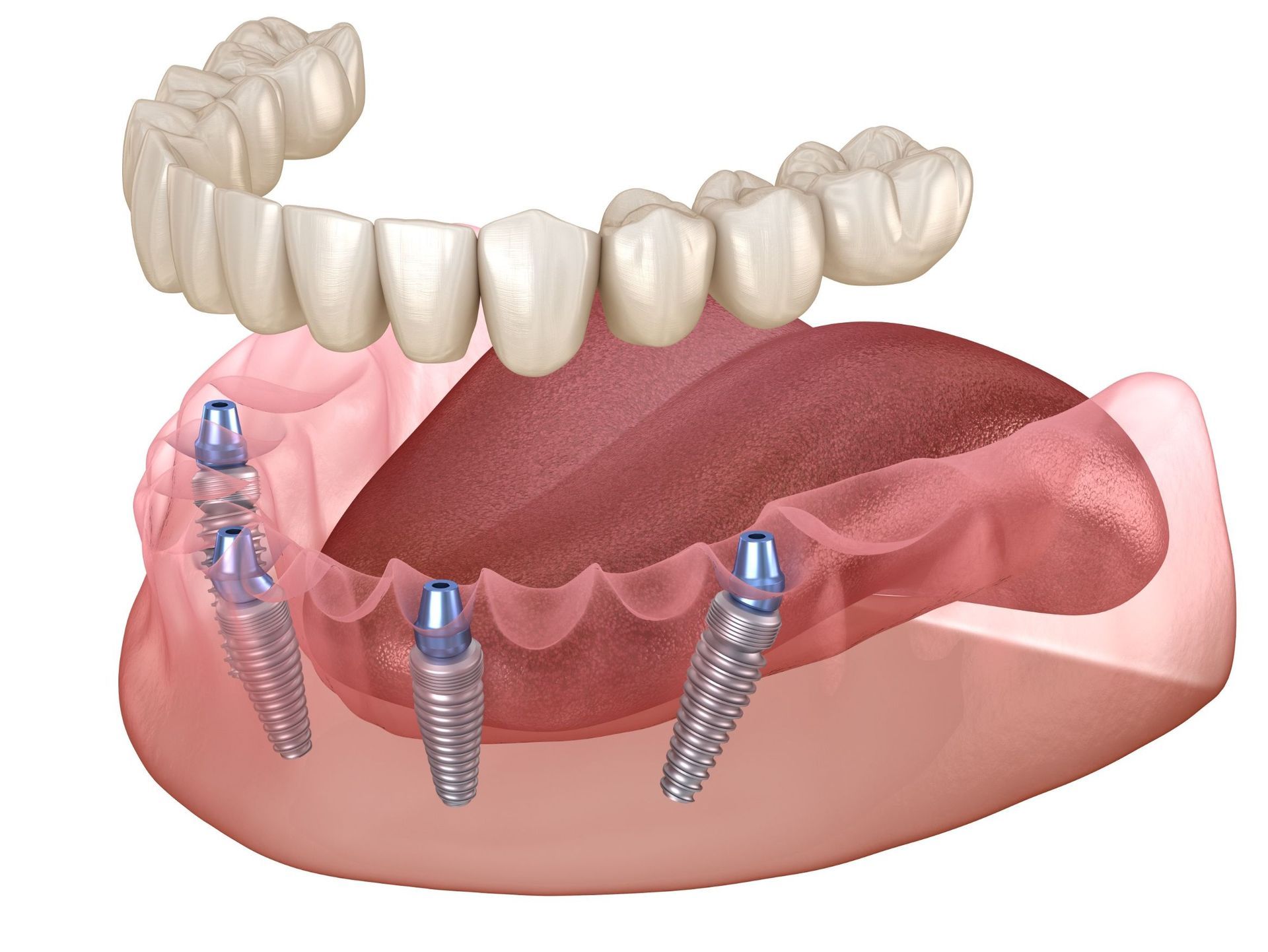 Una imagen generada por computadora de una dentadura con implantes dentales.