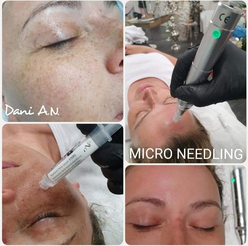 nail and beauty center daniela Microneedling 