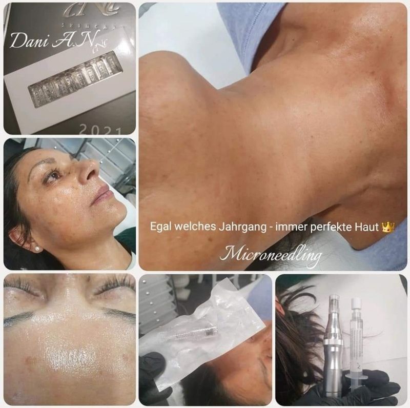 nail and beauty center daniela Microneedling 