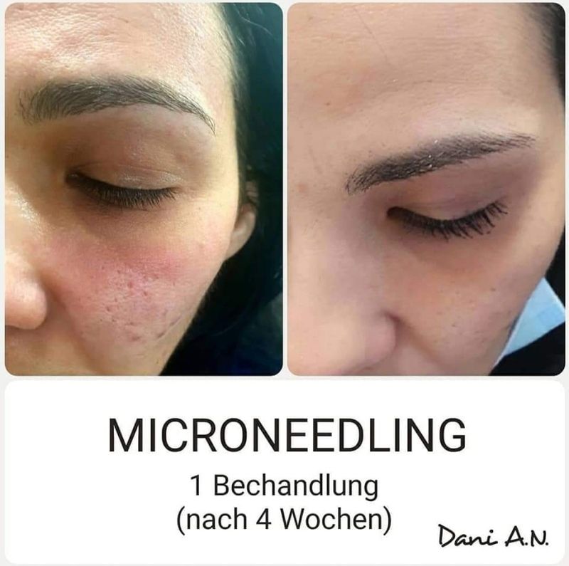 nail and beauty center daniela Microneedling 