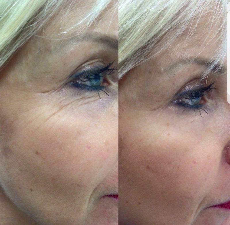 nail and beauty center daniela Microneedling Faltenreduktion