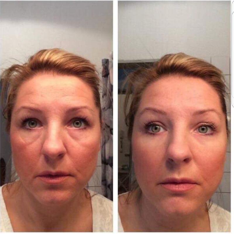 nail and beauty center daniela Microneedling Faltenreduktion