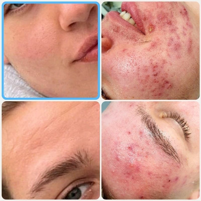 nail and beauty center daniela Microneedling Aknetherapie