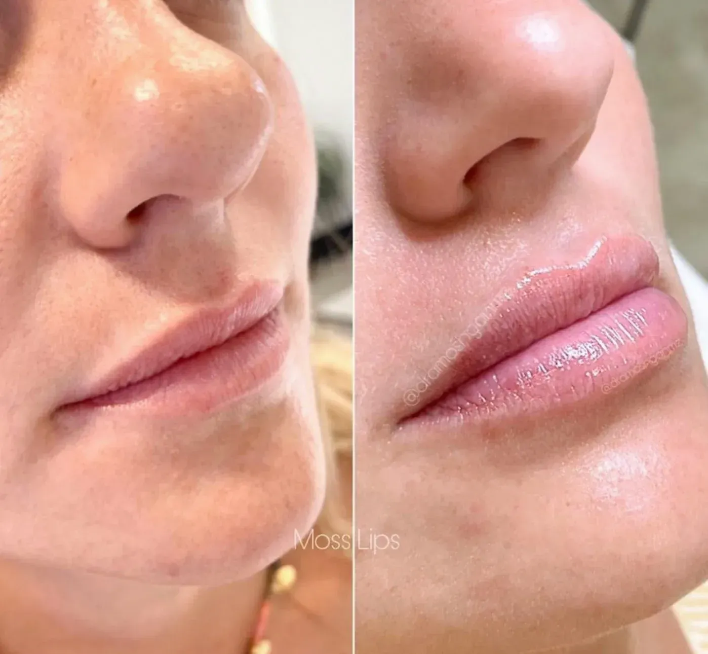 Una foto de antes y después de los labios de una mujer.