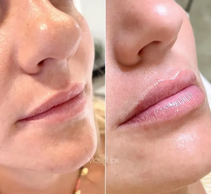 Una foto de antes y después de los labios de una mujer.