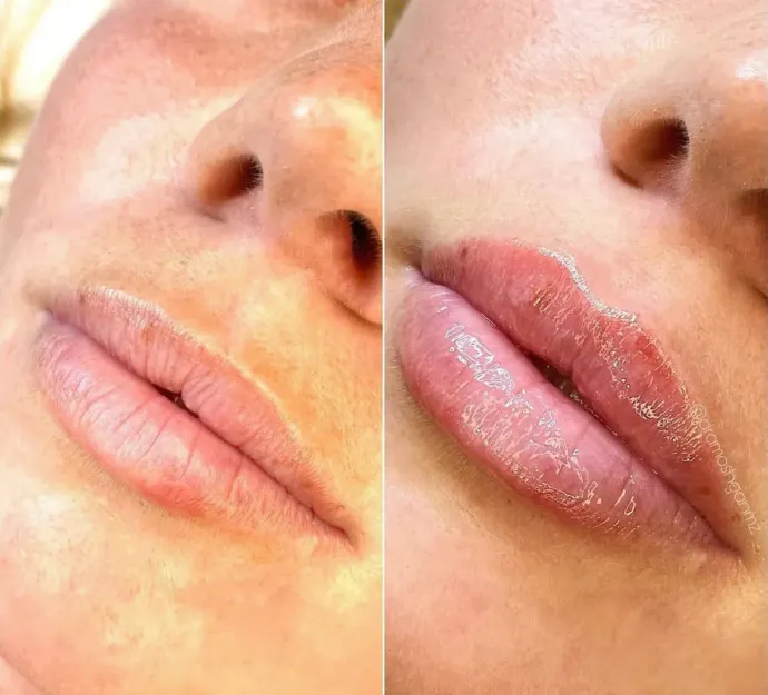 Una foto de antes y después de los labios de una mujer.
