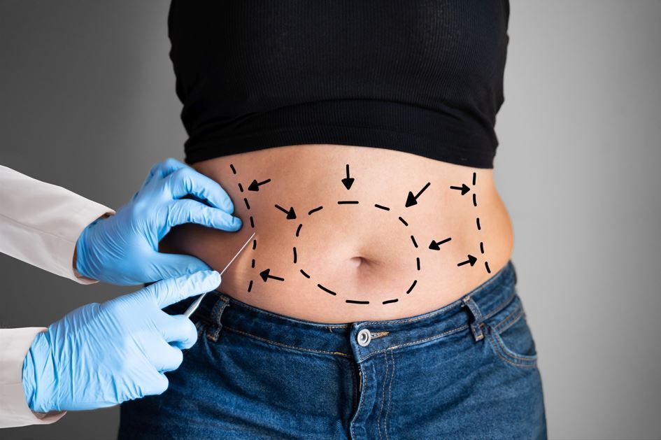 Abdomen de la persona marcado con líneas punteadas y flechas, manos enguantadas del médico sosteniendo un instrumento.