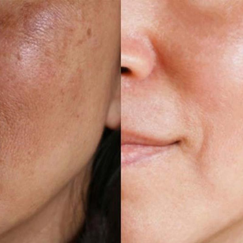 Se muestra el rostro de una mujer antes y después de un tratamiento.