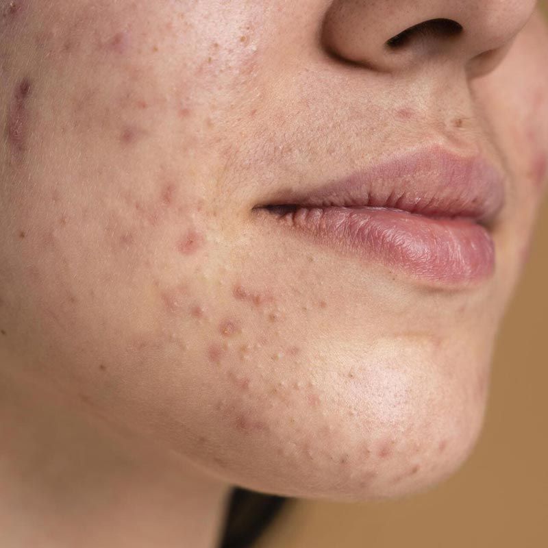 Un primer plano del rostro de una mujer con acné.