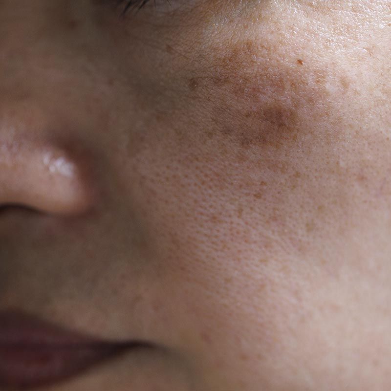 Un primer plano del rostro de una mujer con manchas.