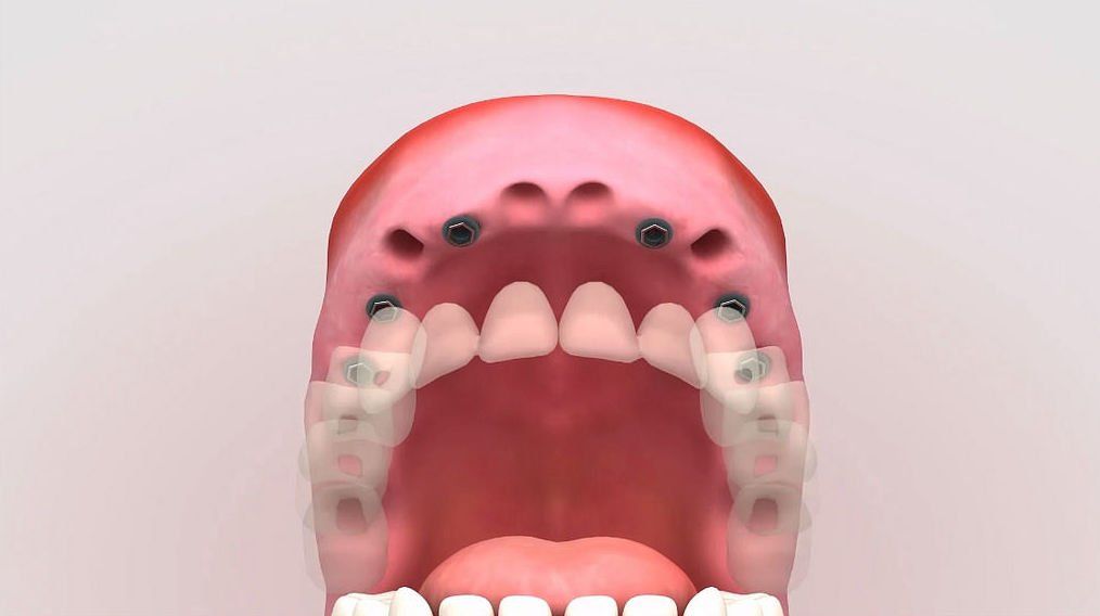 Impresiones dentales digitales en 3D