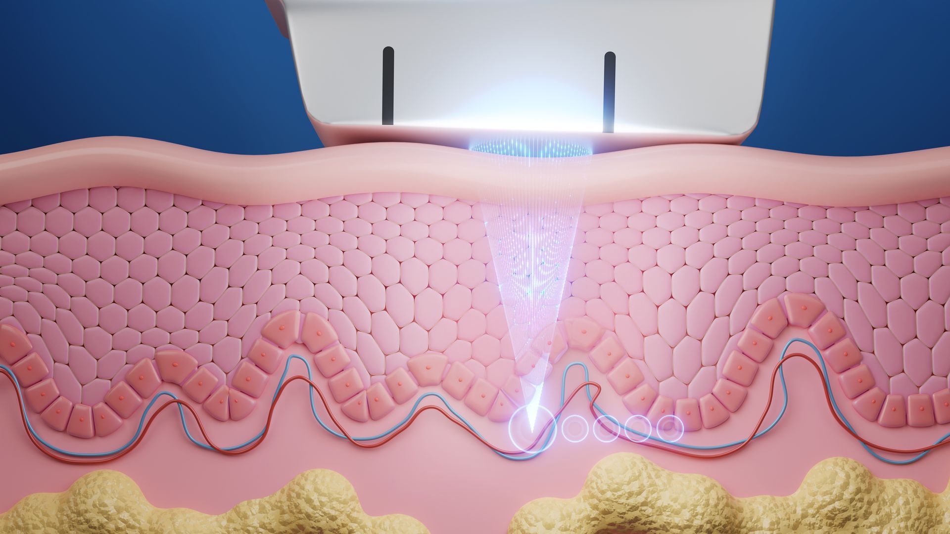 Schéma des effets des ultrasons sur la peau