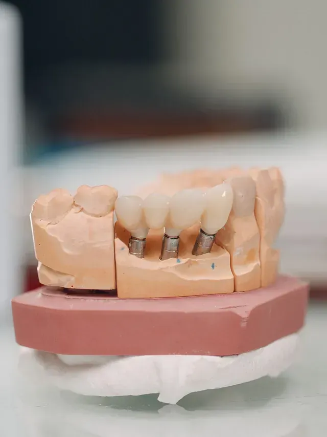Modelo de implante dental que muestra tres dientes artificiales unidos a postes.
