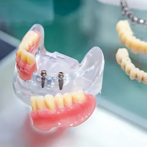 Modelo de implantes dentales con dientes y mandíbula limpia, primer plano.