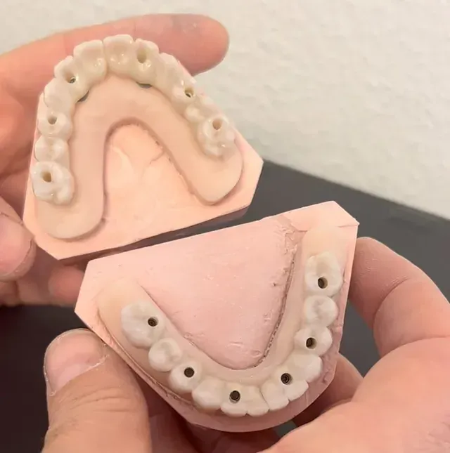 Manos sosteniendo dos moldes dentales de color rosa con marcadores de posición de dientes blancos, probablemente para dentaduras postizas.