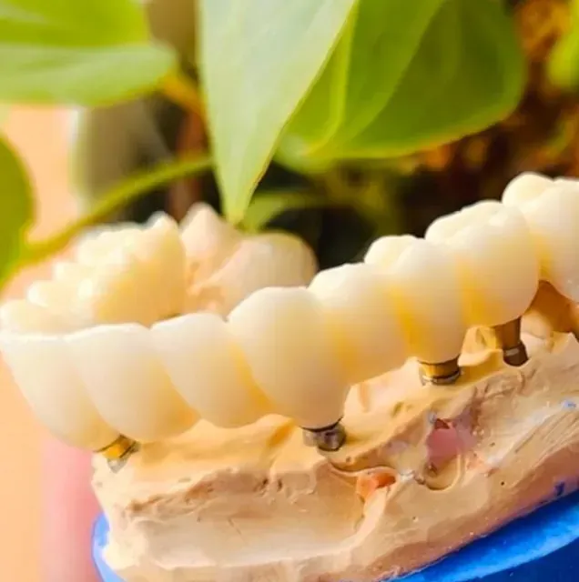 Modelo de puente dental, dientes de color crema, montado sobre una base de yeso con vegetación circundante.