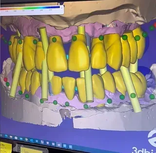 Escaneo dental 3D que muestra modelos de dientes amarillos y guías de alineación verdes.