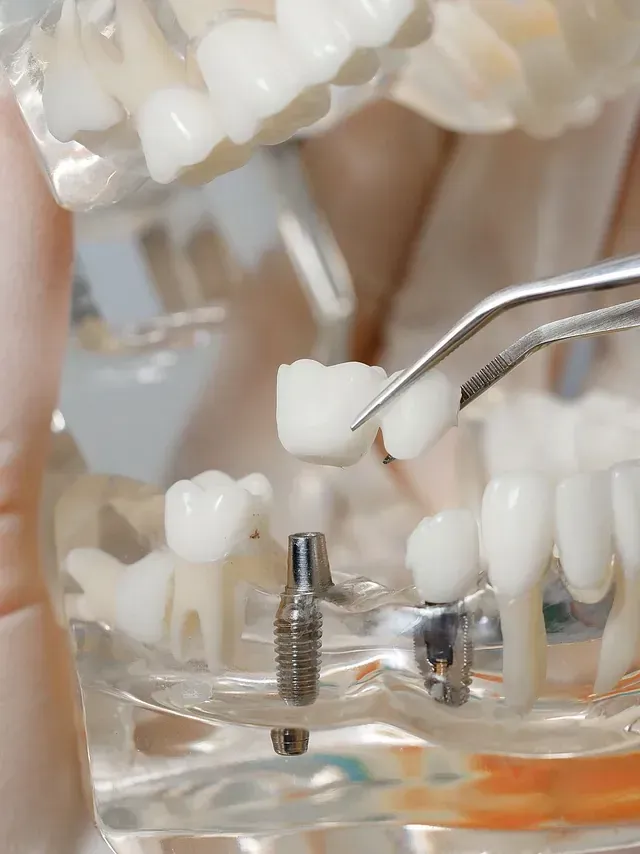 Modelo dental que muestra una corona que se coloca sobre un implante dental.