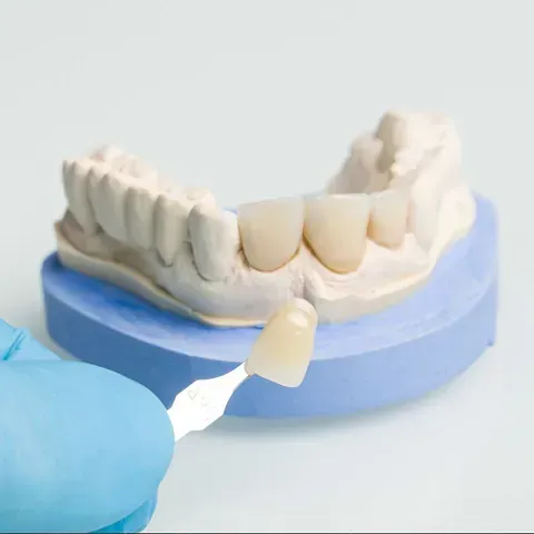 Mano sosteniendo una carilla dental contra un modelo de dientes; guante azul, base azul.