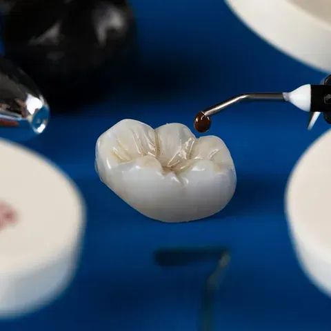 Corona dental siendo trabajada con herramientas, sobre una superficie azul.