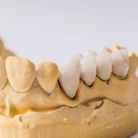 Modelo dental con dientes, mostrando varias carillas dentales blancas.